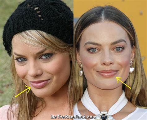 margot robbie lip fillers.